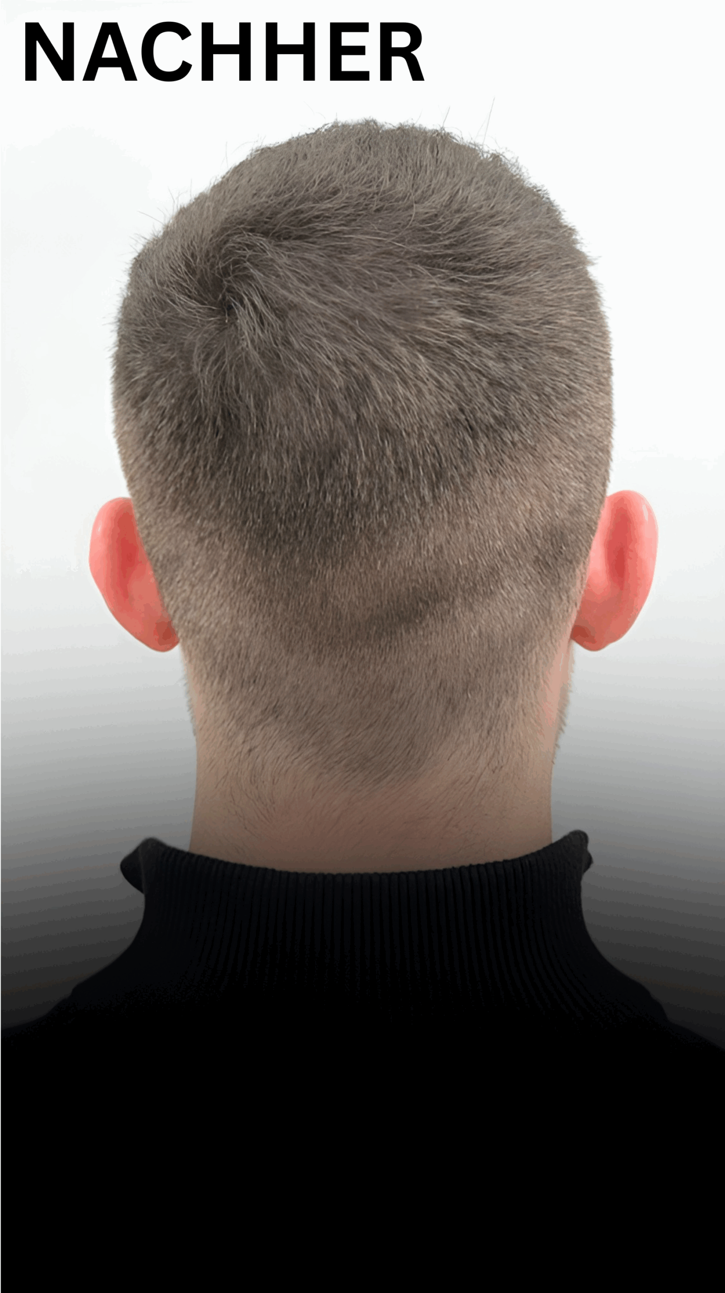 Aderans Schütthaar Nachher Haarverdichtung