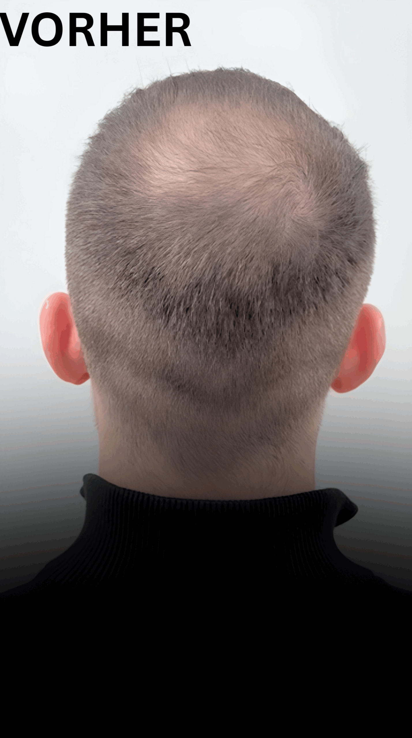 Aderans Schütthaar Vorher Haarverdichtung